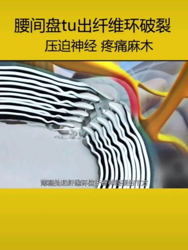 腰间盘突出