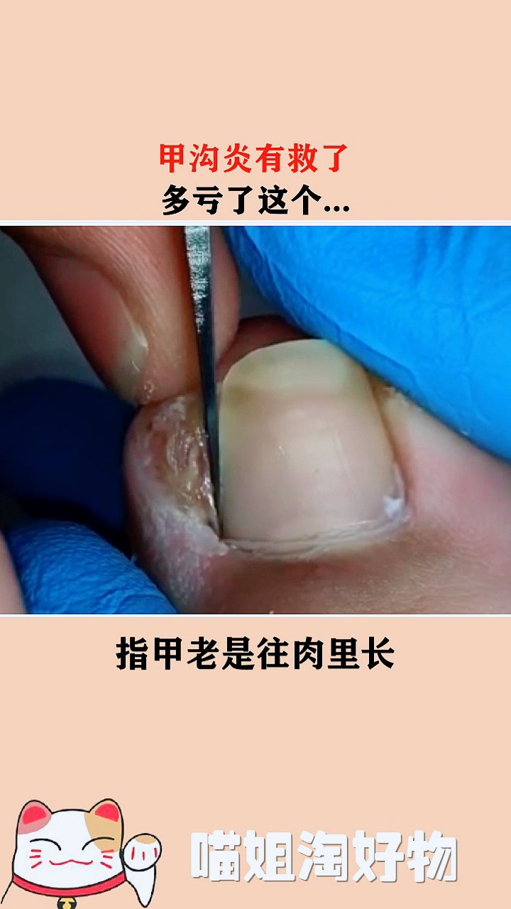 #2020春运#指甲长肉里的痛苦你体会过吗
