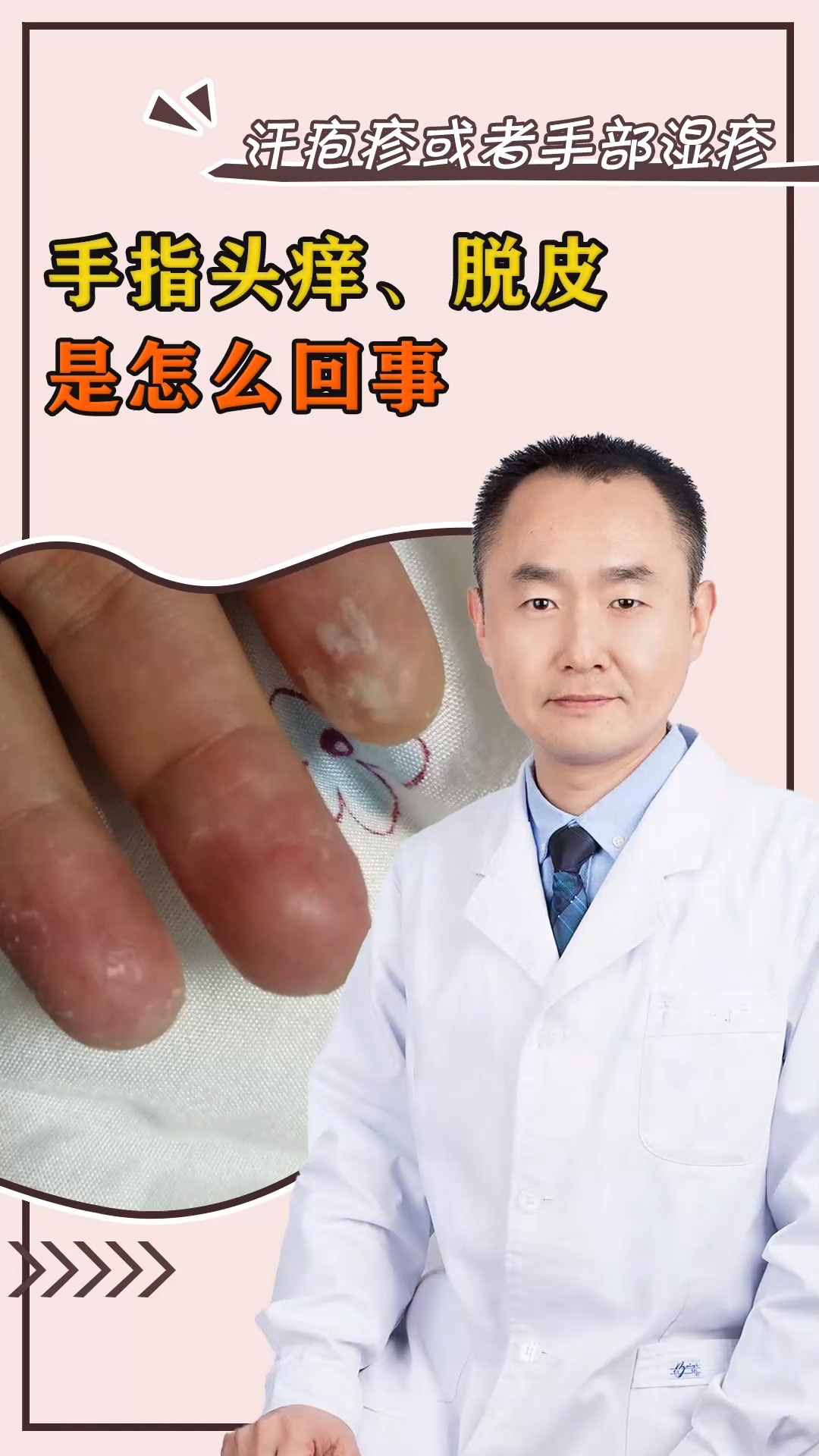#健康养生#手指头痒,脱皮怎么回事?
