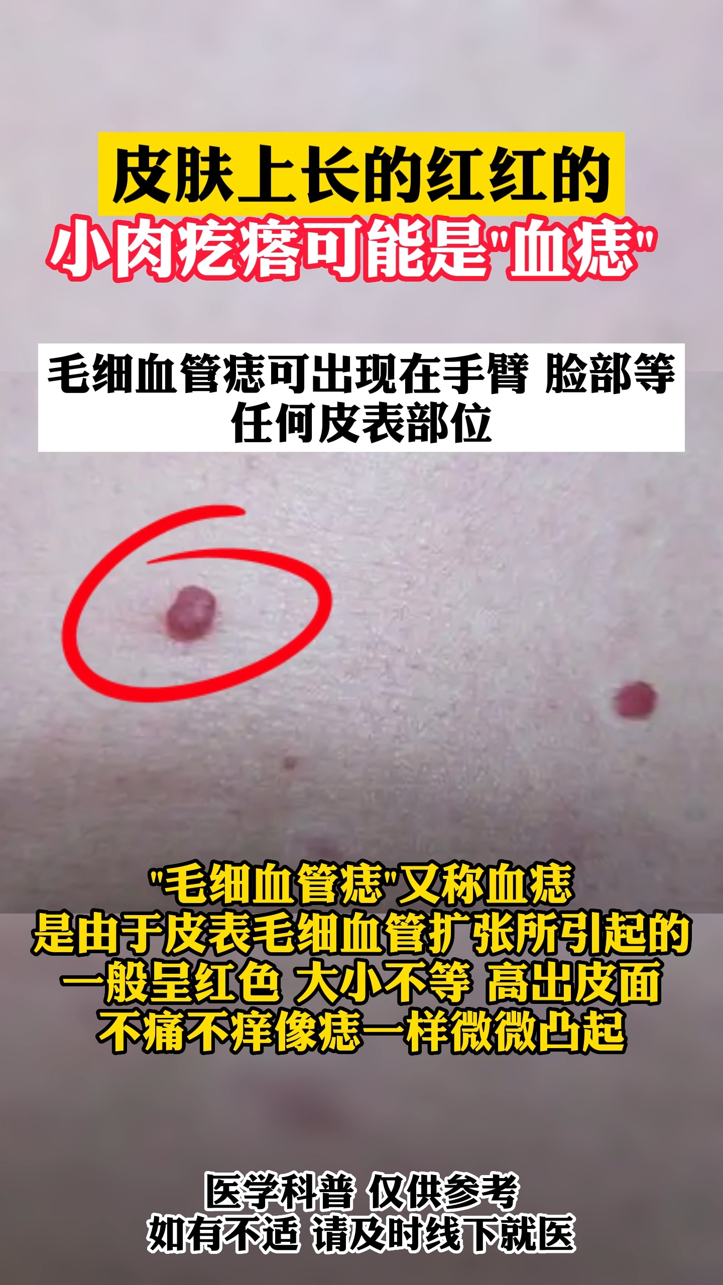 #皮肤问题#身上突然长出血痣,难道是身体出问题了吗?快看看是怎么回事?