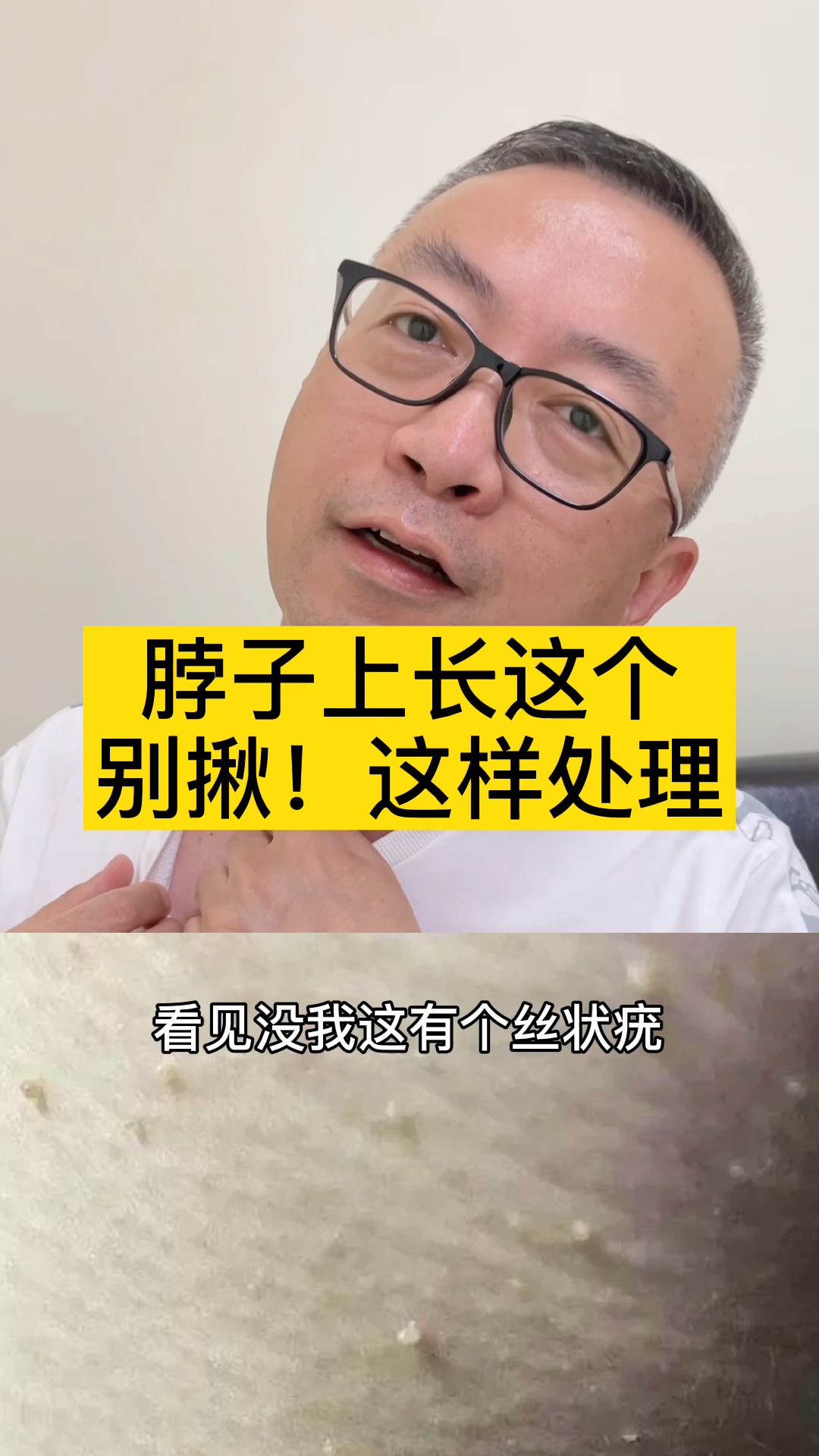 #猴子扁平疣肉揪一擦就掉#脖子长小肉疙瘩怎么办？这个其实叫丝状疣，很多人会揪掉，别揪，这样