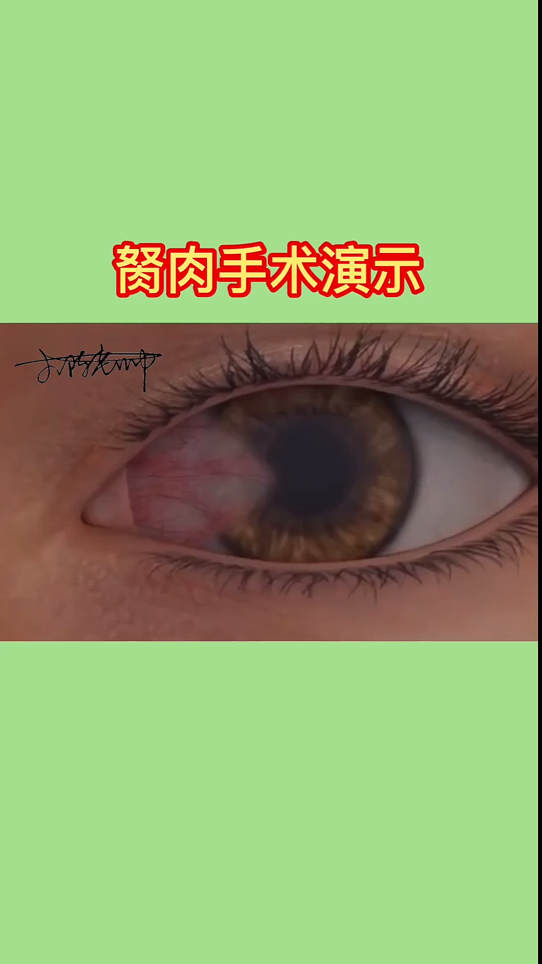 #眼部胬肉手术#眼睛是心灵之窗,平时一定要注意眼部养护,预防大于一切!