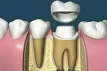 牙齿根管治疗是什么?根管治疗疼不疼?