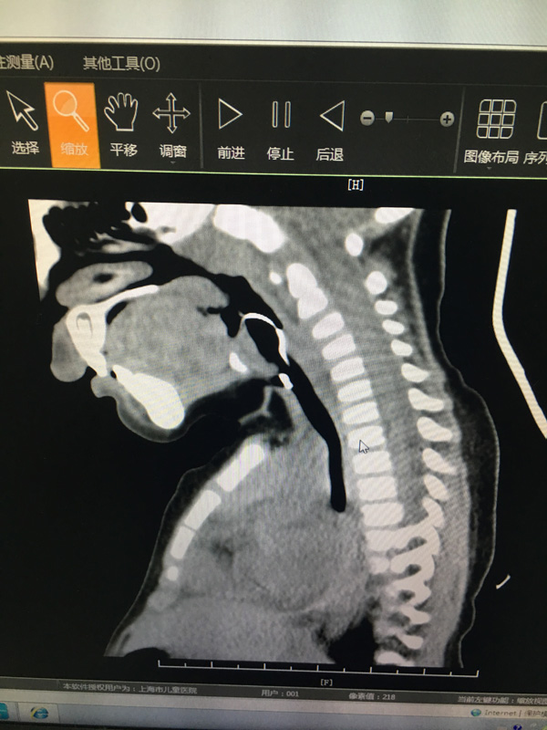 声门CT图片
