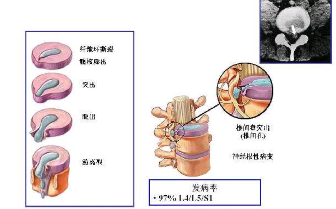 腰间盘突出病理示意图图片