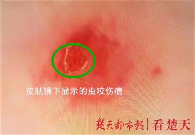 寝室变蚊虫"避暑圣地",男子双腿被飞虫咬成"千疮百孔"