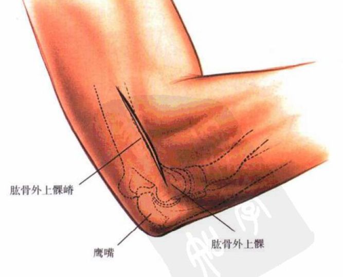 肱骨外上髁炎怎么办?4个方法很有效,舒筋活血,消炎止痛!