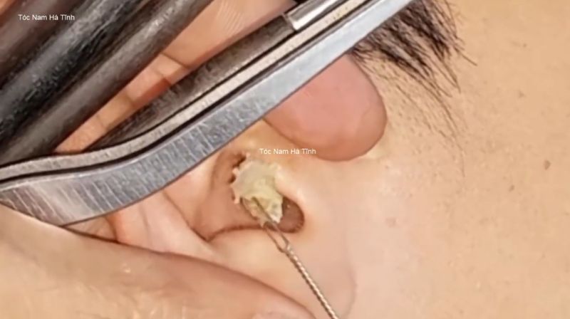 技师给客人清洁耳朵，客人多久没掏耳屎了，技师一次都清洁不完3359次播放