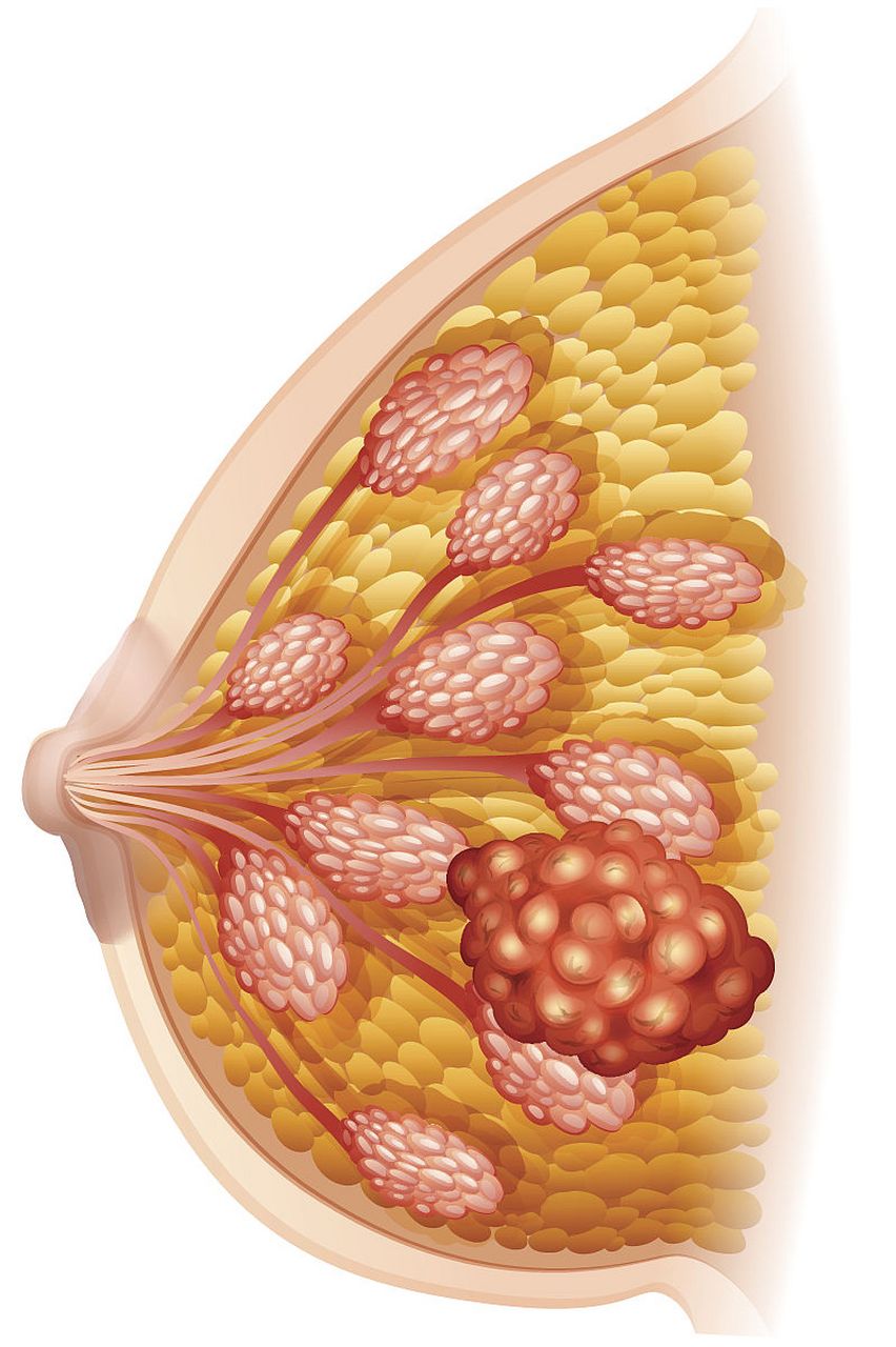 重度乳腺增生图片