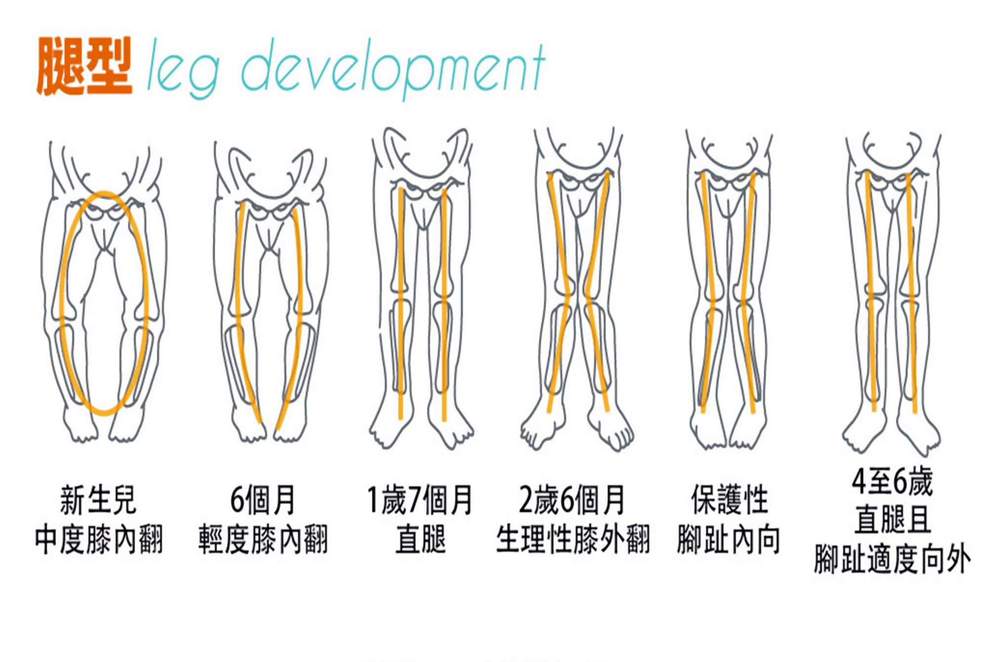 宝宝臀纹不对称是啥样子?如何识别?有啥隐患?晚发现难治愈