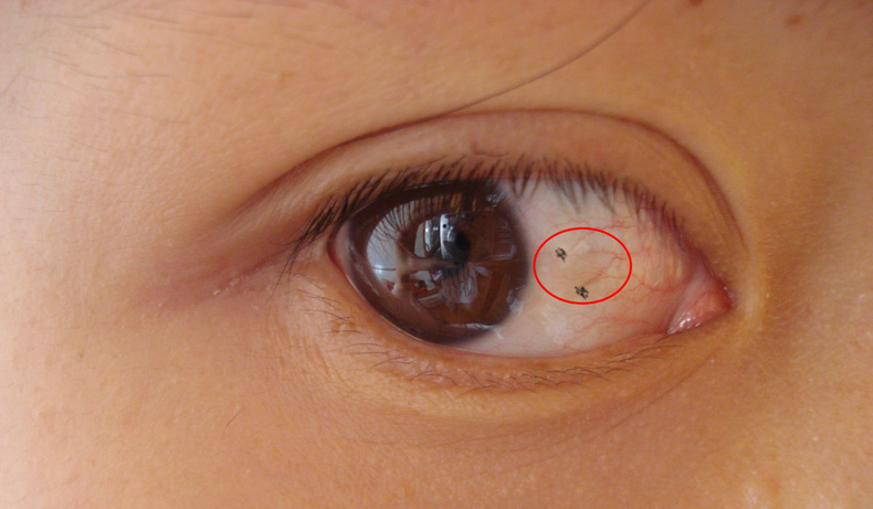 眼白结膜色素痣图片