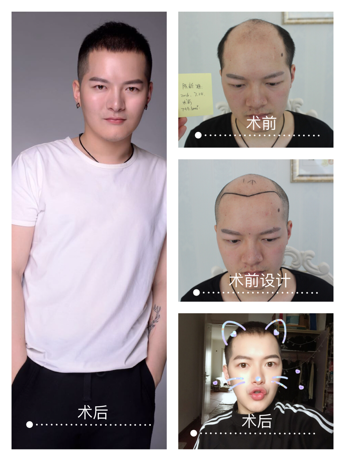 脱发治疗,发际线种植手术前后对比