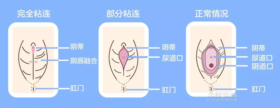 别急别急 这其实 是一种常见的疾病 医学上称之为 阴唇粘连 造成这种
