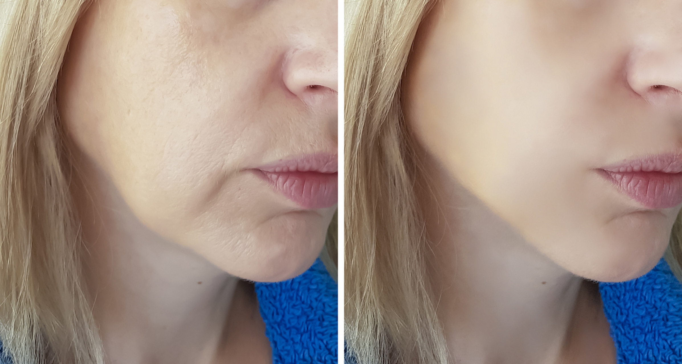 法令纹的消除,有两种方式? 注射填充法令纹有两种方式:一个是玻尿酸填