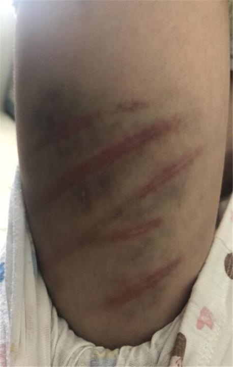 10岁女童疑遭家暴,全身数十道血痕青紫一片 有的已经结痂 其父竟这样