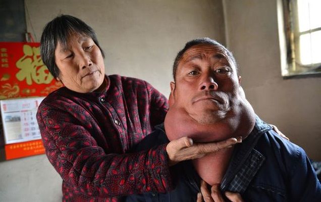 为何皮下会长出脂肪瘤这种恼人的小疙瘩?不妨来了解