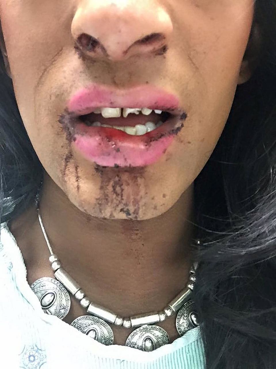 它通常表现为口角部位的皮肤变得红肿,疼痛和破裂有