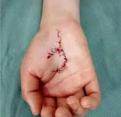 多人家中手筋被割断,竟因这件小东西,很多人却不以为然