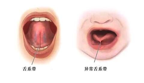 舌系带什么样正常图片图片