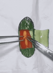 骨折复位后,钢板固定, 钻孔,测深,攻丝. ▼