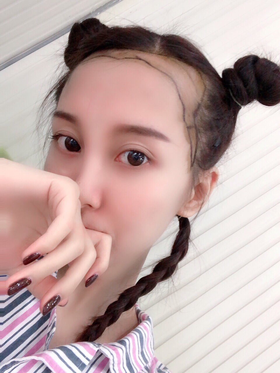 90后大脑门少女植发后分享 这些知道的太晚了