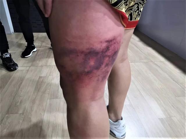 中国搏击新星横空出世,小将强势击败潇杀狂,赛后大腿淤紫!