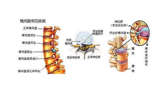 和派圓針:腰椎間盤突出的六大症狀,你中招了嗎