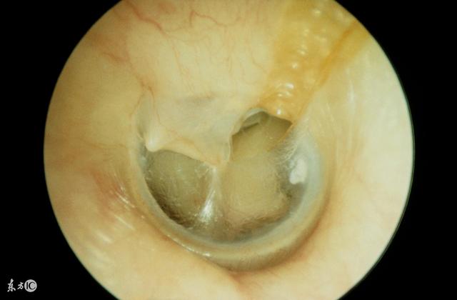 鼓膜外伤相关知识