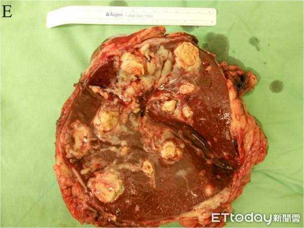 赤脚散步惹祸!他患类鼻疽胃狂喷白脓 割脾脏保命