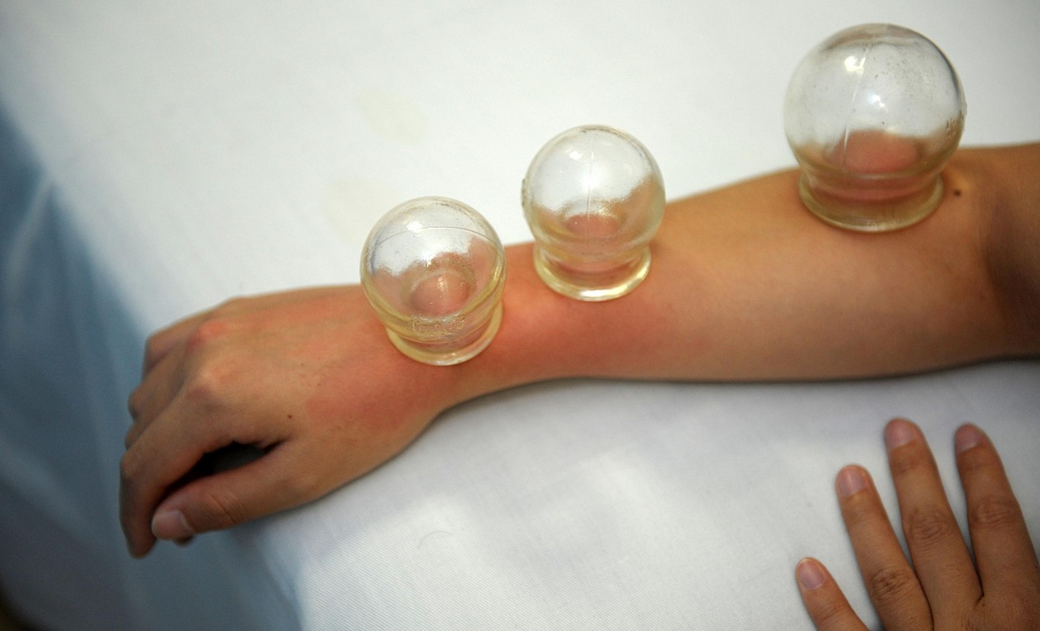 然而,就像任何医疗方法一样,拔火罐也有其利与弊.