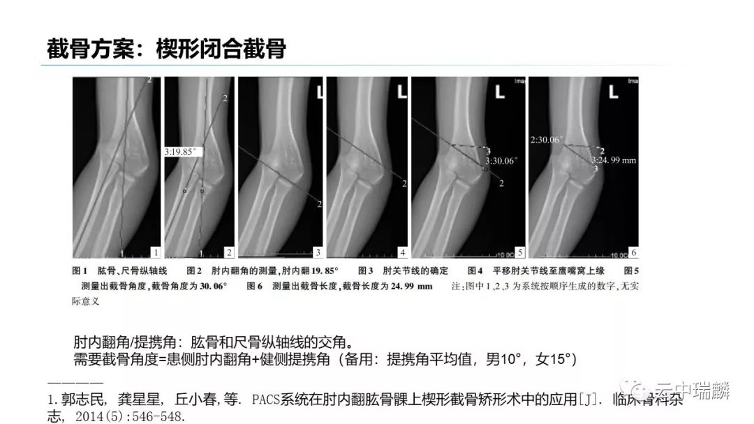 肘内翻的术前测量及截骨设计