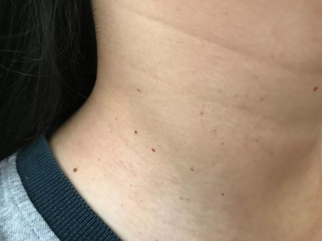 长在这些部位的"小肉赘"用治吗?它是什么东西,会不会传染呢?