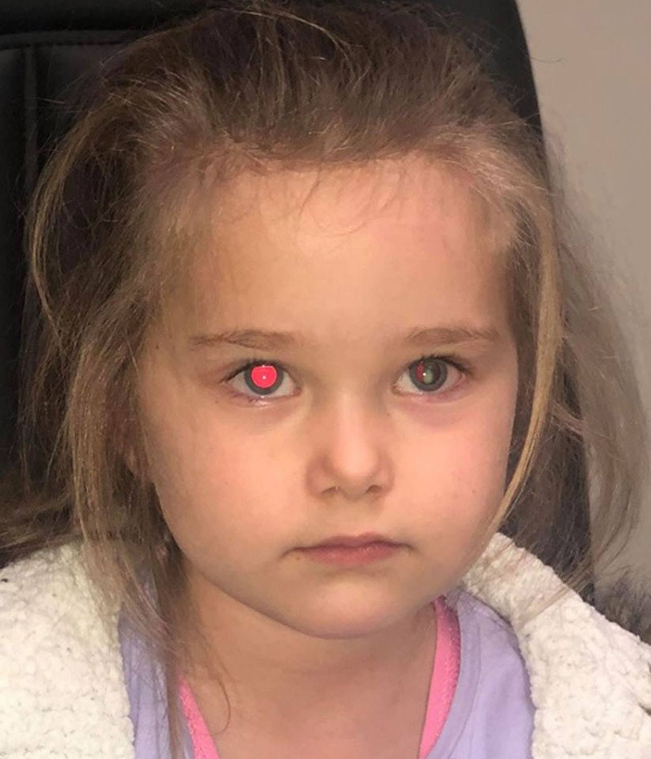 拍照时发现女儿的瞳孔有白色斑点,妈妈带去医院检查吓坏