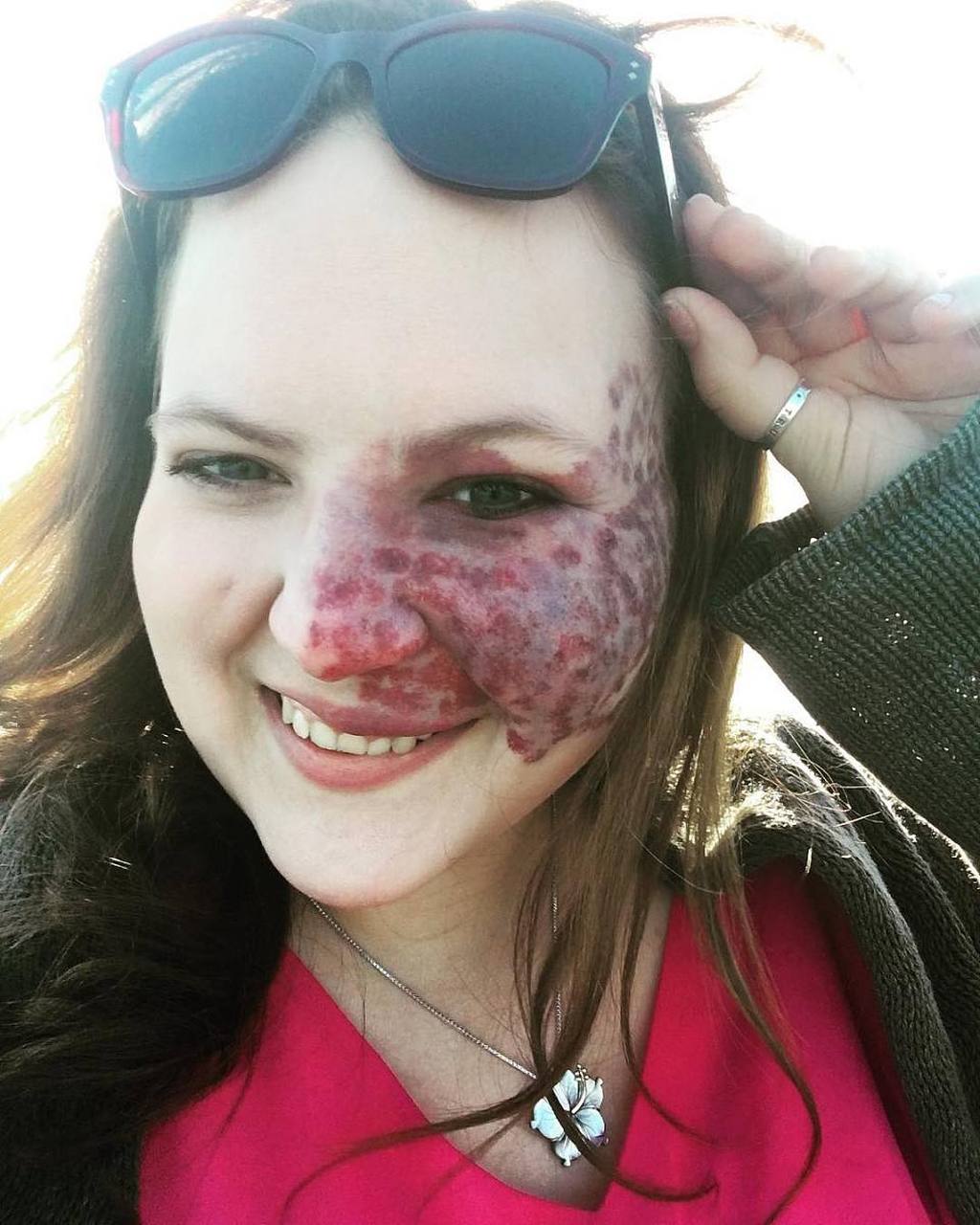 胎记可以去除掉吗  胎记是可以去除掉的.