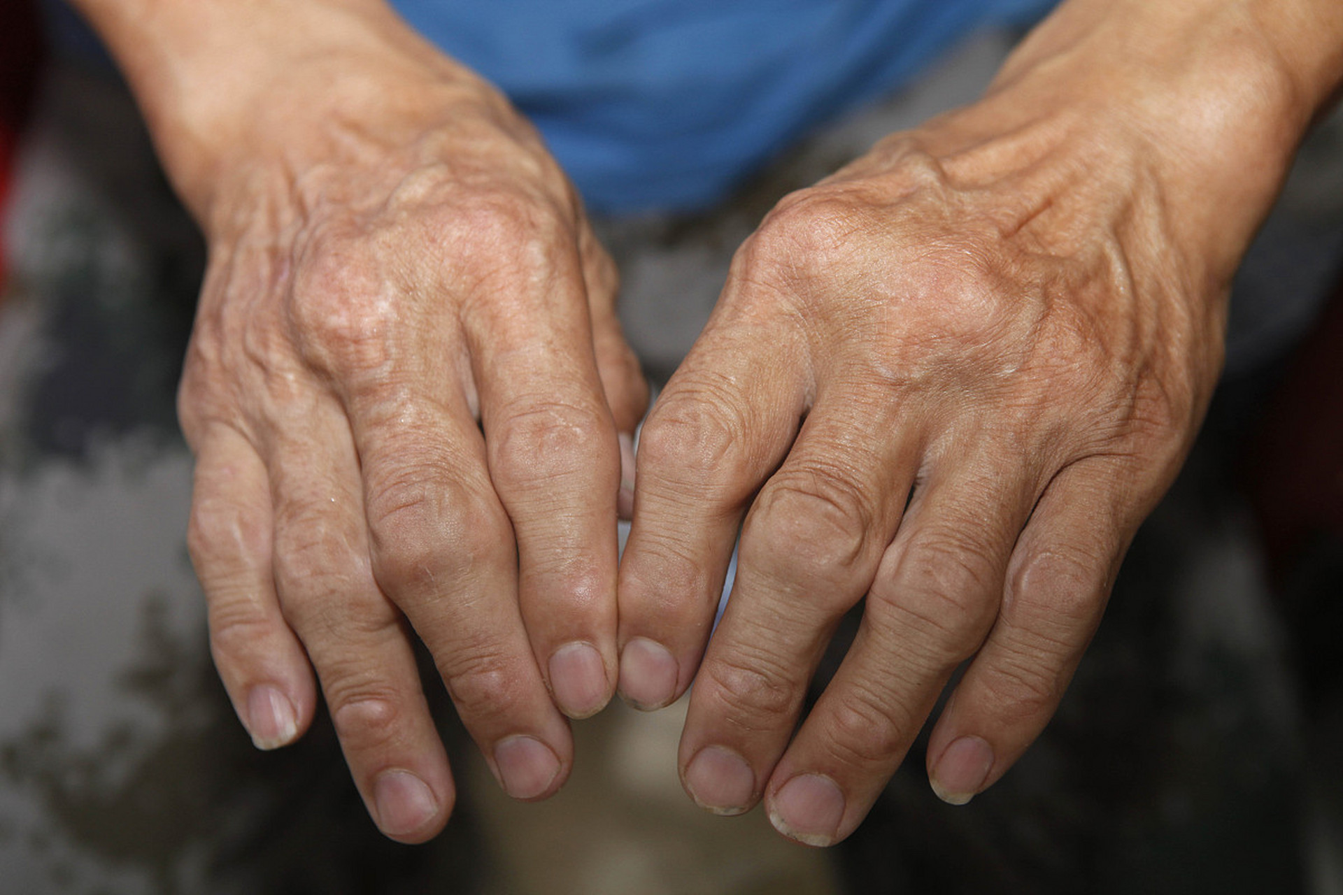 类风湿患者 抵抗力差怎么办?