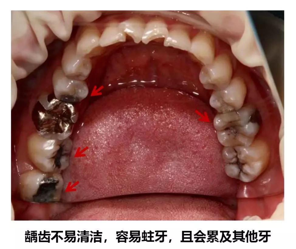 当智齿没有足够空间生长,脱离轨道,与邻牙之间产生缝隙,容易嵌塞