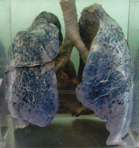 抽烟人的肺多年图片