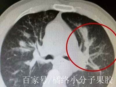 肺钙化能活多久 baijiahao.baidu.com