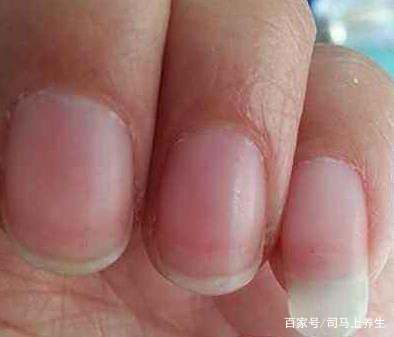 指甲诊病,学习一下,有好处 指甲诊病,学习一下,有好处