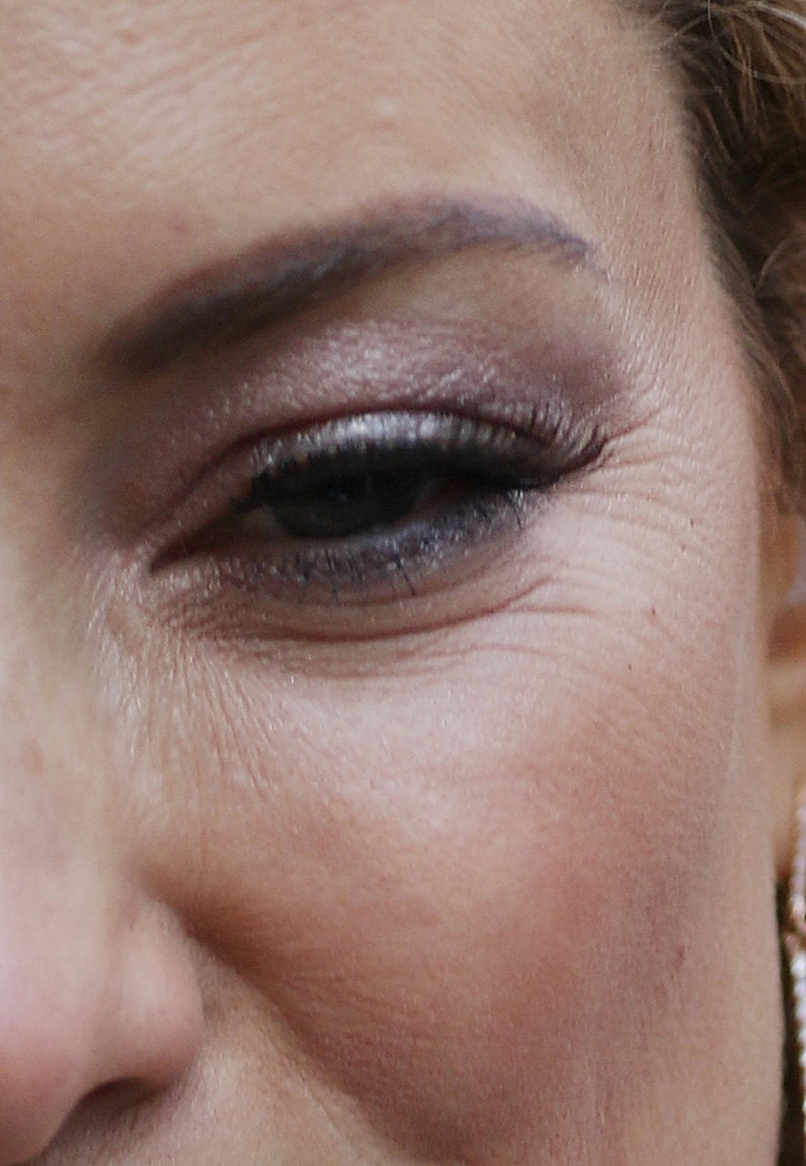 眼角细纹怎么去除?