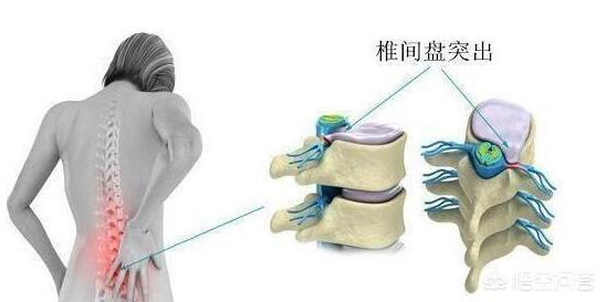 腰间盘突出导致的腰突腿麻,腿痛麻木如何治疗?腰间盘不再是腰痛