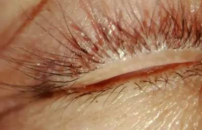 睫毛上为什么也会长虱子