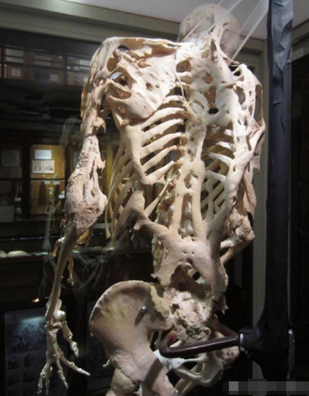 进行性肌肉骨化症是一种罕见的遗传性疾病(又叫"珊瑚人"),病人身上的