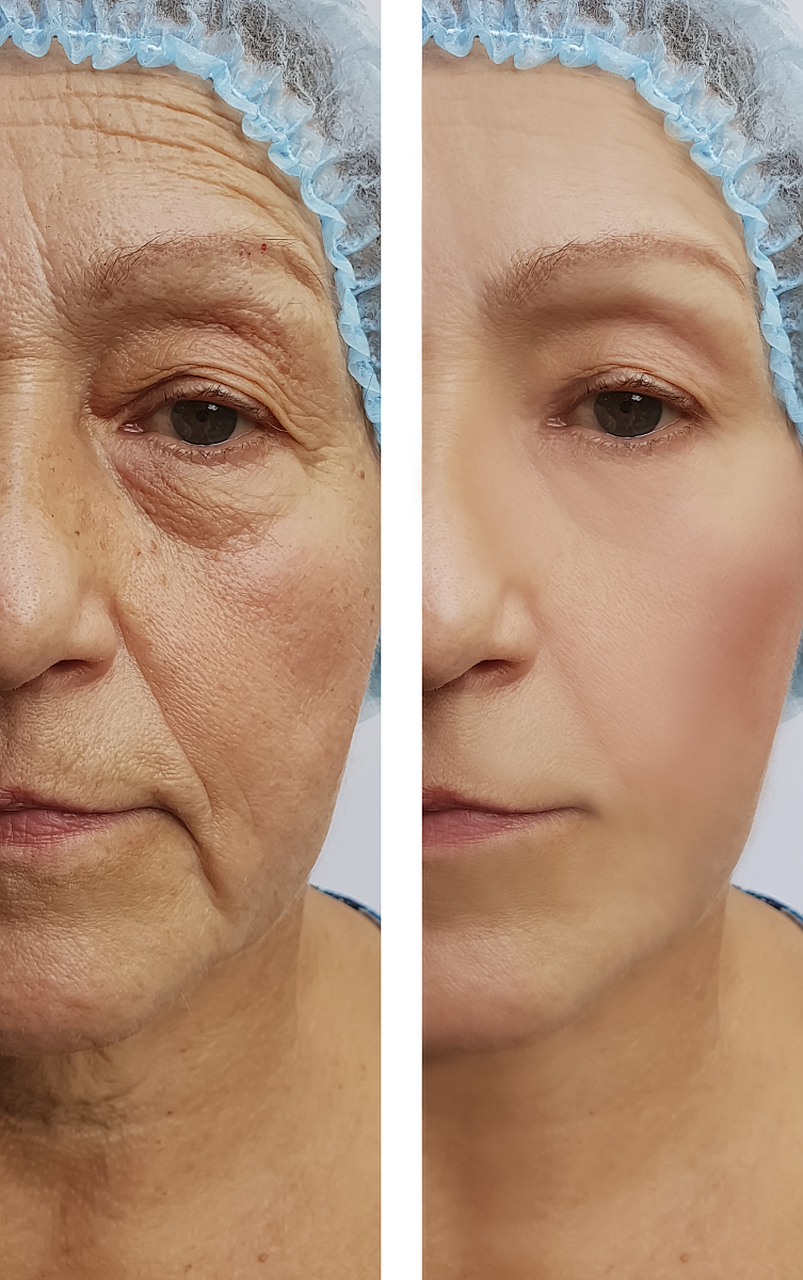 大拉皮手术能维持多久大概多少钱 #医美科普挑战赛# #医美#   大拉皮