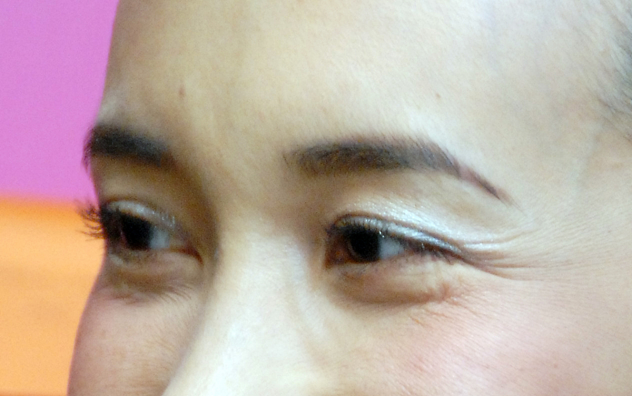 两眉之间竖纹怎么去掉  两眉之间的竖纹一般是川字纹,可以去掉,方法如