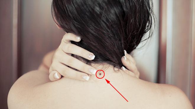 "痣"在好运来,脖子后面有三颗痣的人,贵人运旺,富贵命好!