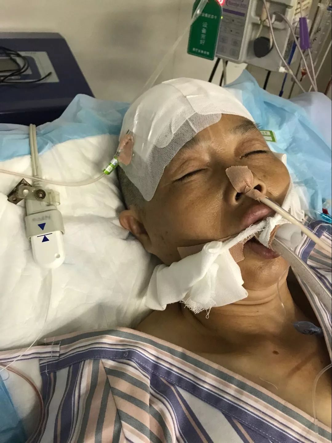 浙医学子求助:母亲烟雾病突发颅内出血危在旦夕