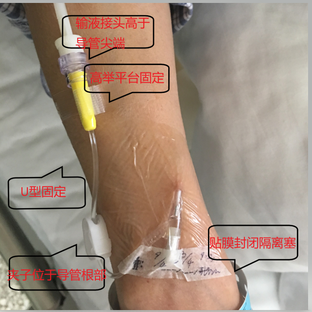 留置针固定的一个中心五个要点