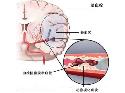 脑栓塞示意图图片