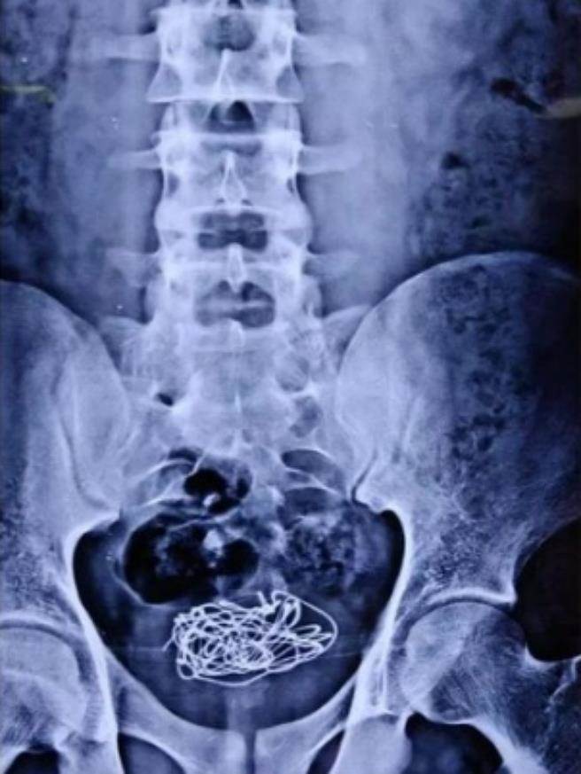 印度18岁少年腹痛「膀胱拉出电线」 医师追问真相超尴尬!